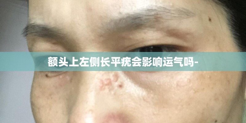 额头上左侧长平疣会影响运气吗-